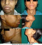 Before After Pictures,Delhi,tissue expansion, scar removal 